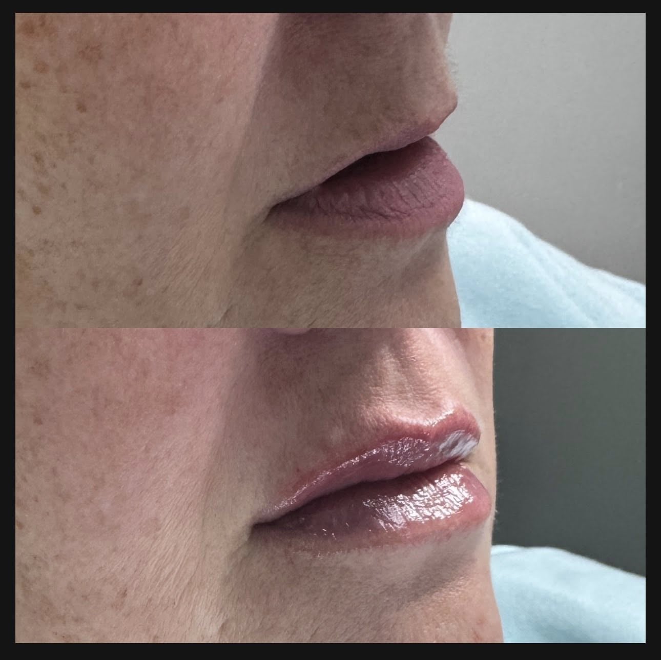 Lip filler before and after results at Glow Medical Group