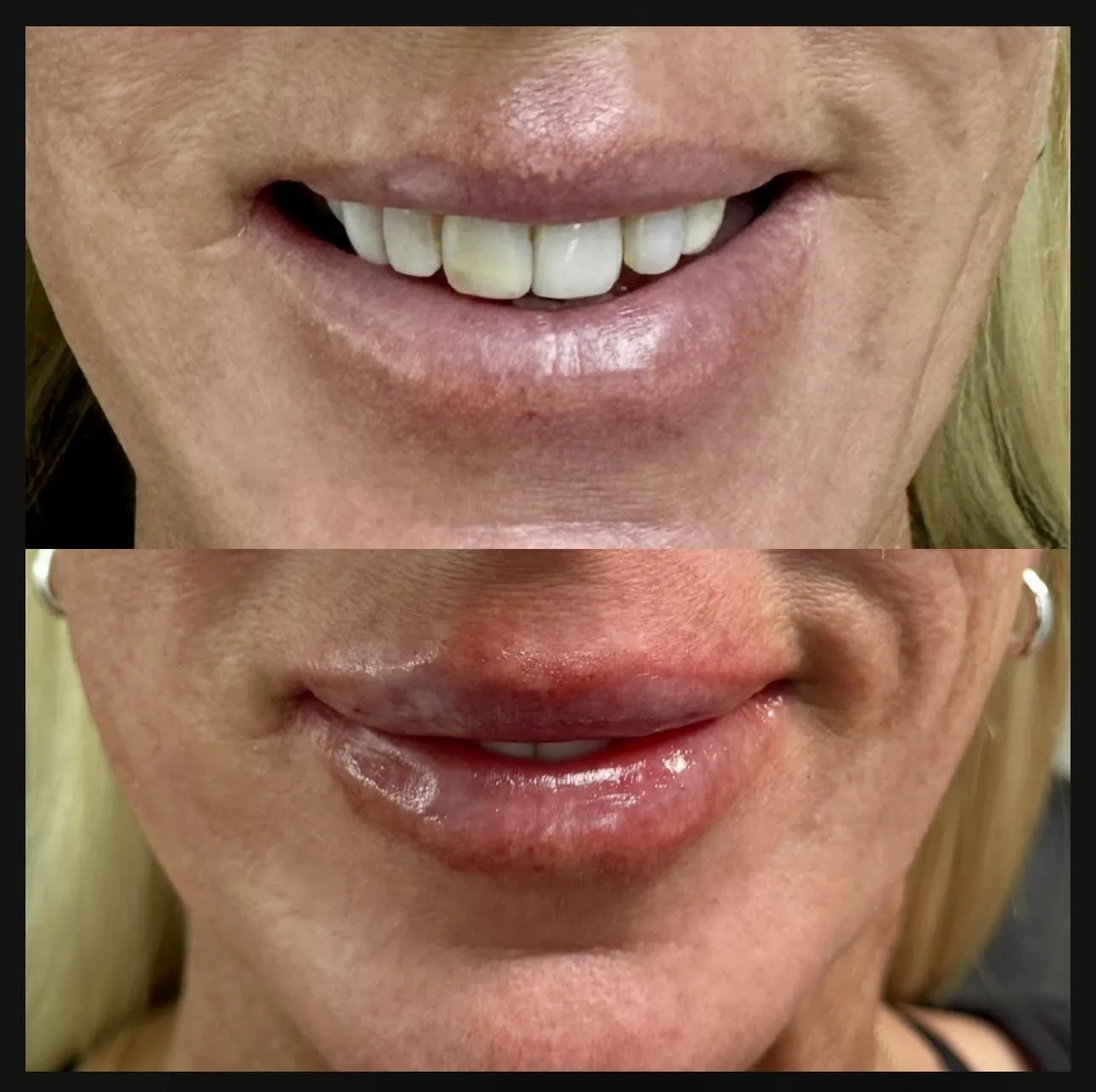 Lip filler before and after at Glow Medical Group