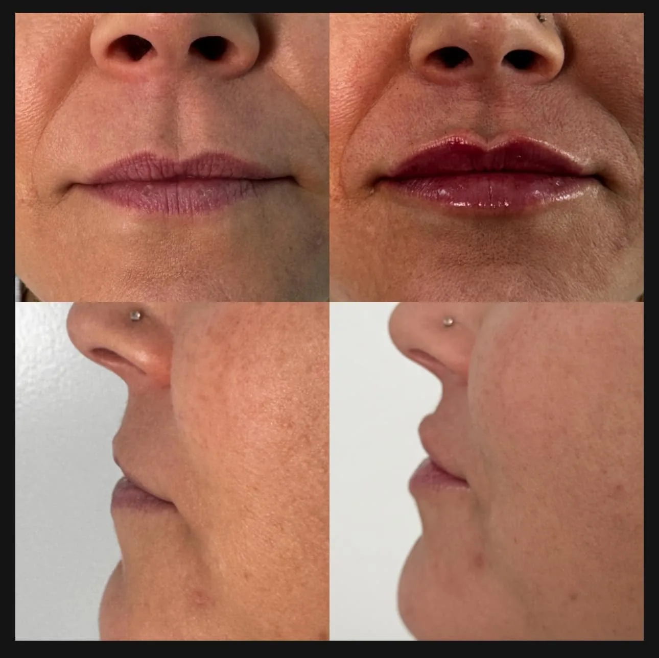 Lip filler before and after at Glow Medical Group