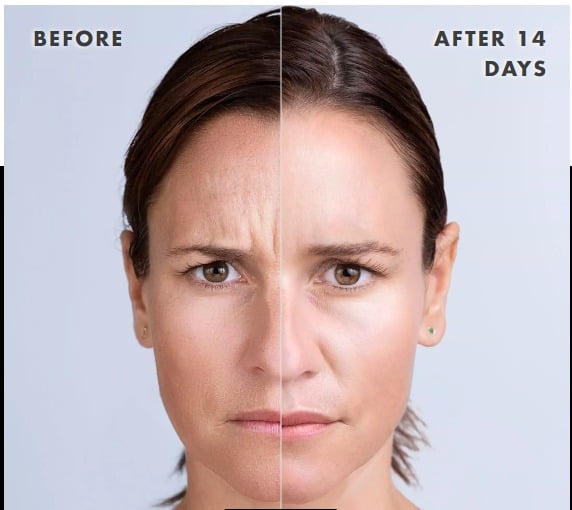 Xeomin neurotoxin before and after results