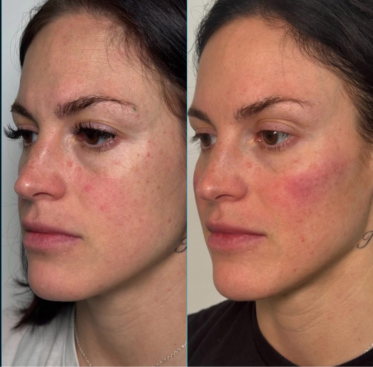 Cheek filler before and after at Glow Medical Group