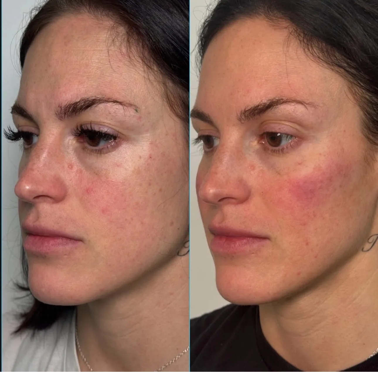 Cheek filler before and after at Glow Medical Group