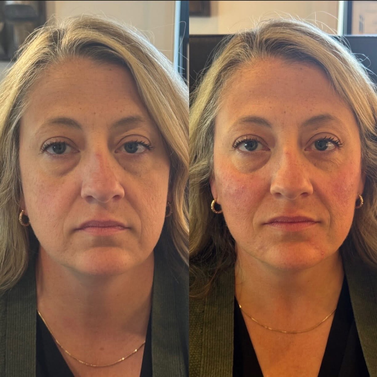 Dermal filler before and after at Glow Medical Group
