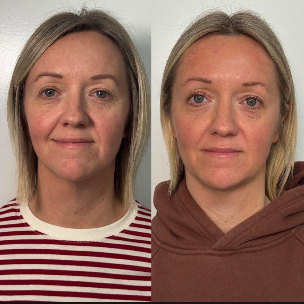 Dermal filler before and after at Glow Medical Group