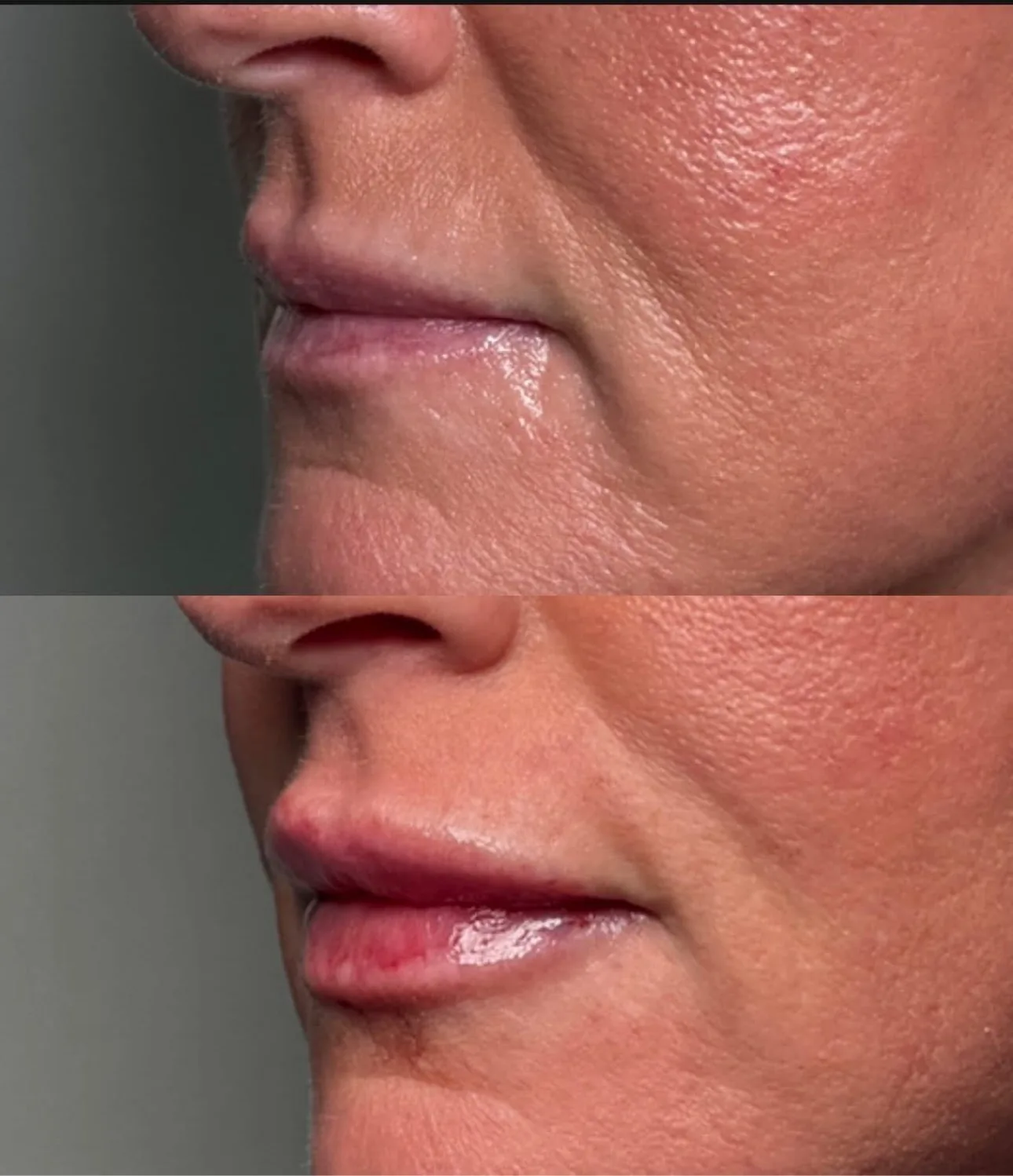 Lip filler before and after at Glow Medical Group