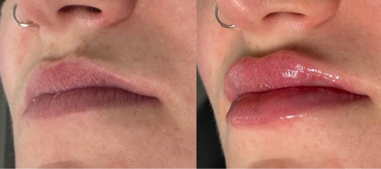 Lip filler before and after at Glow Medical Group