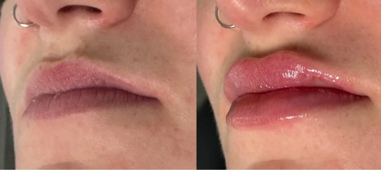 Lip filler before and after at Glow Medical Group