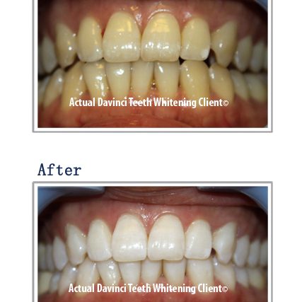 Teeth whitening before and after at Glow Medical Group