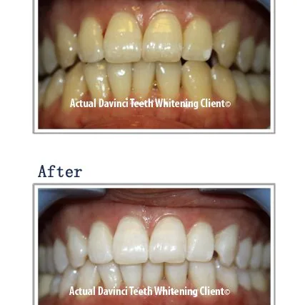 Teeth whitening before and after at Glow Medical Group